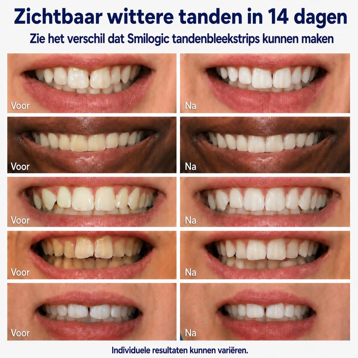 Smilogic Whitening Strips thumbnail 7