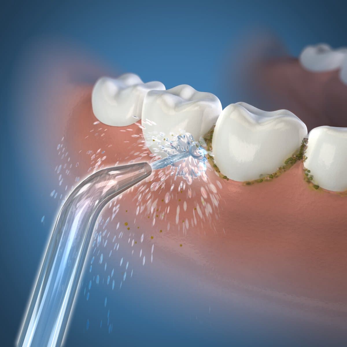 Waterpik JT-100 Jet Tips Opzetstukken (2 stuks) thumbnail 4